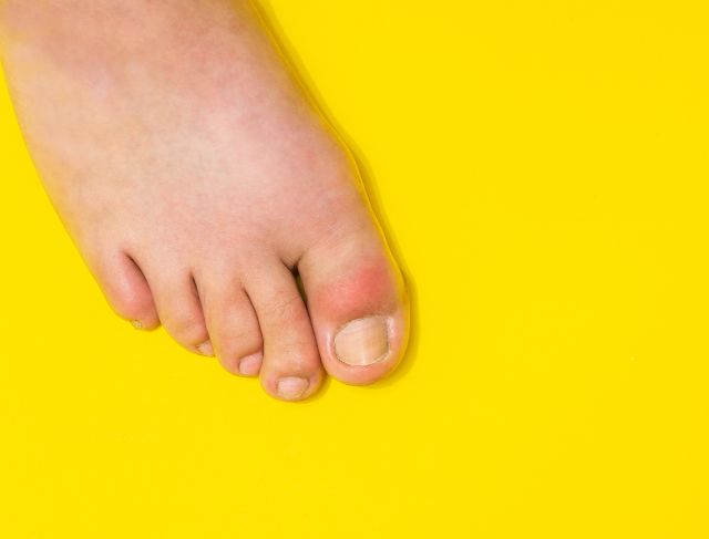 Sembuh dari Asam Urat Tanpa Obat Seumur Hidup