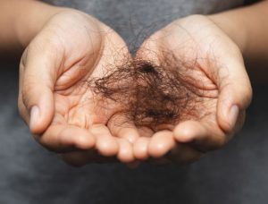 Cara Mengatasi Rambut Rontok Berlebihan Secara Alami dan Medis untuk Mencegah Kebotakan Dini